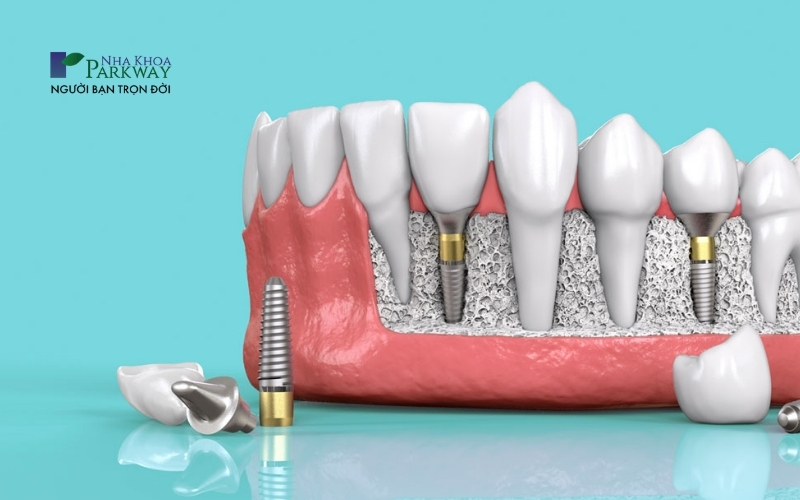 Kỹ thuật trồng răng Implant All On 4 có ưu điểm là nhanh chóng phục hồi và đảm bảo chức năng ăn nhai