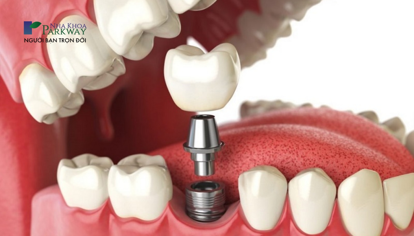 Hình ảnh đang gắn cầu răng sứ vào implant để hoàn thiện quá trình cấy ghép implant