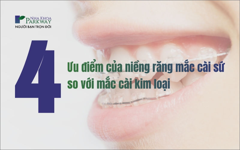 4 ưu điểm của niềng răng mắc cài sứ so với niềng răng mắc cài kim loại