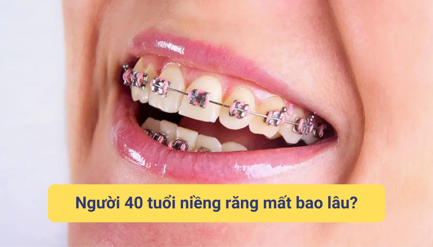 Người 40 tuổi niềng răng mất bao lâu