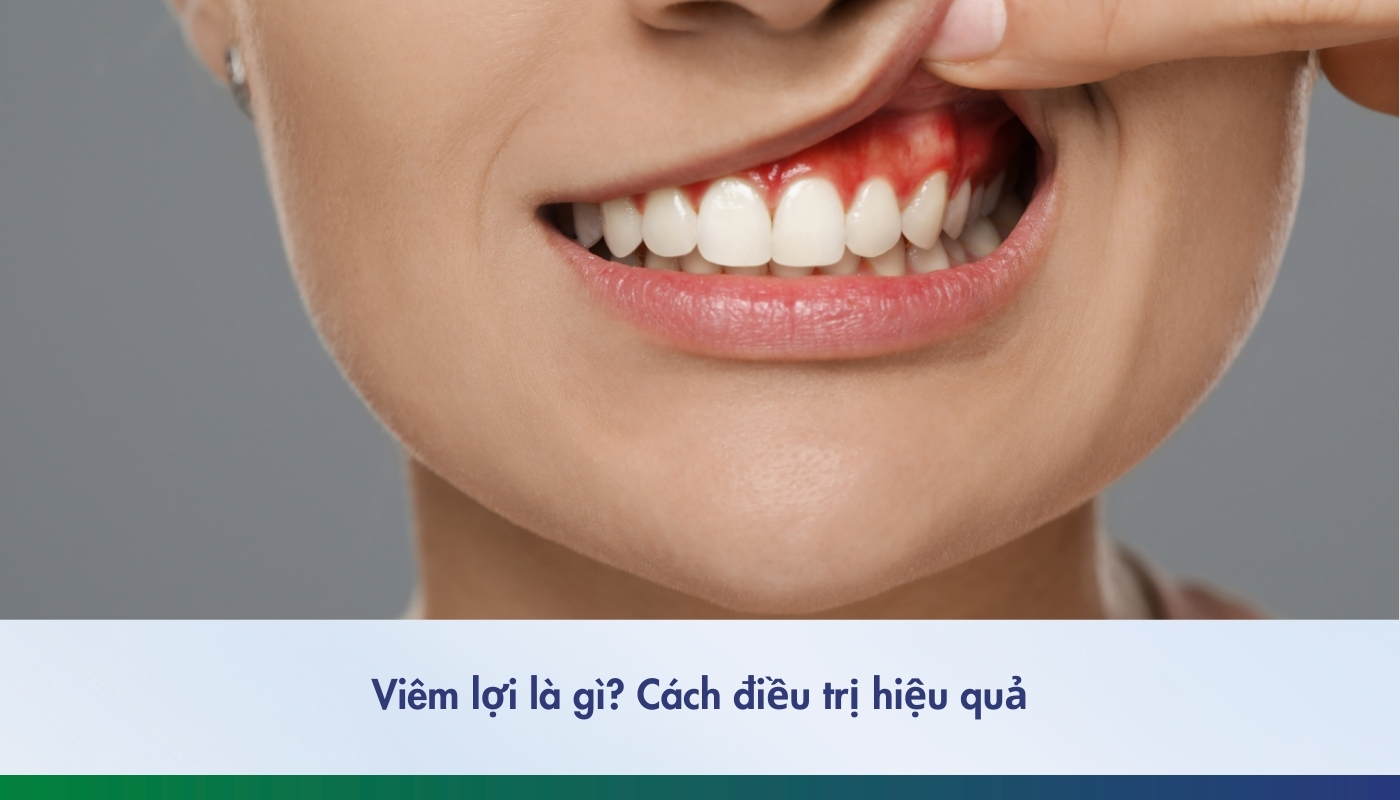 Cách điều trị viêm lợi hiệu quả