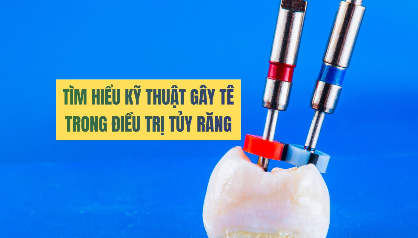 Kỹ thuật gây tê trong điều trị tủy răng - Chia sẻ từ bác sĩ chuyên khoa