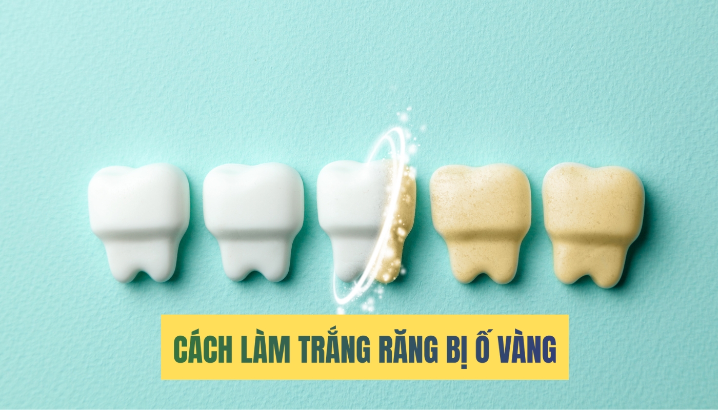 Cách làm trắng răng bị ố vàng