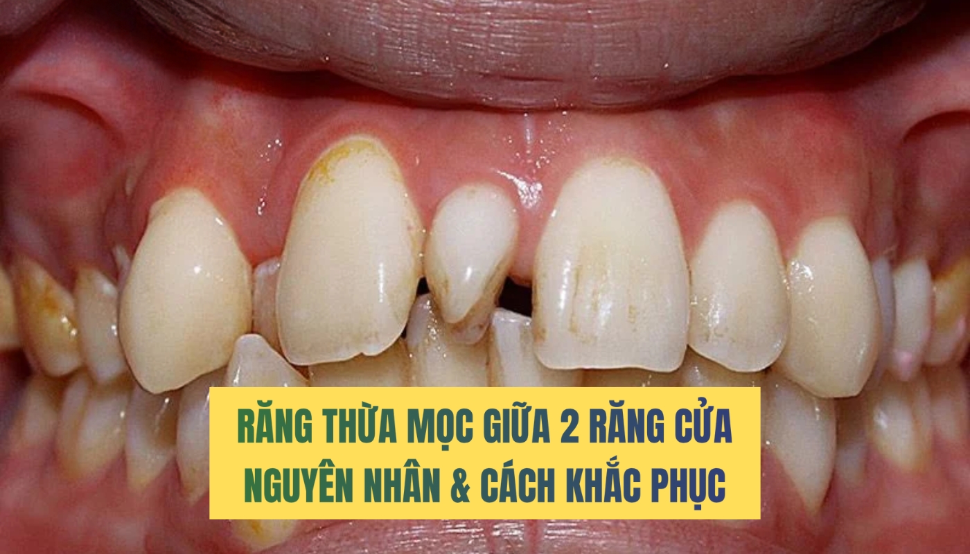 Răng thừa mọc giữa 2 răng cửa