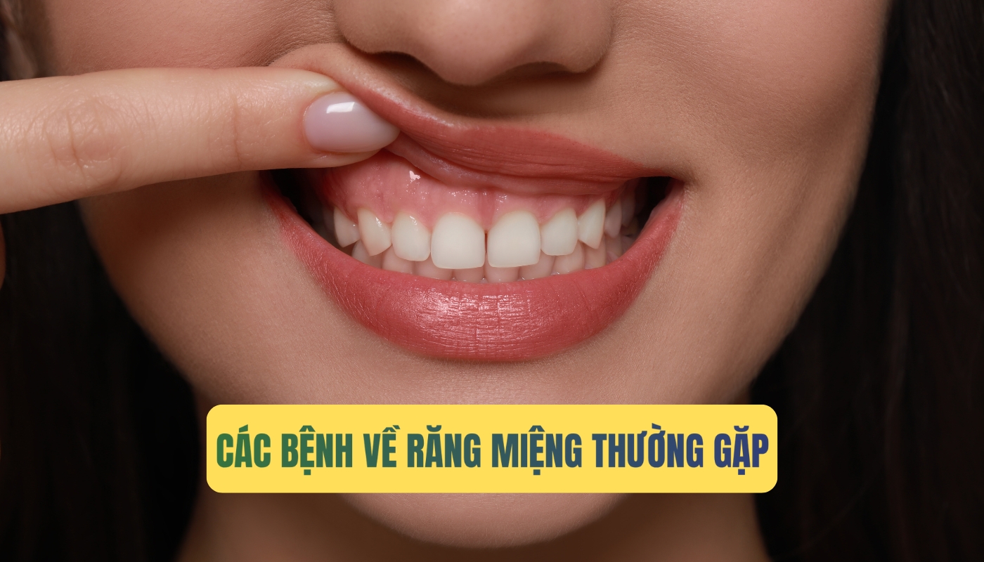 Các bệnh về răng miệng thường gặp