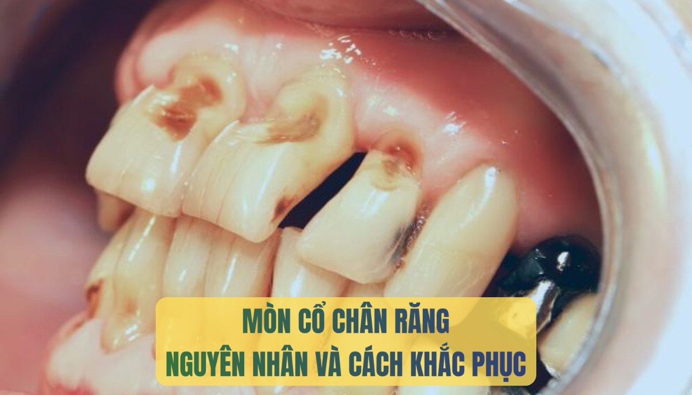 Mòn cổ chân răng