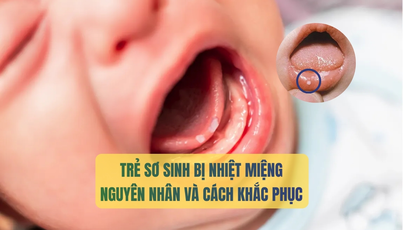 Trẻ sơ sinh bị nhiệt miệng