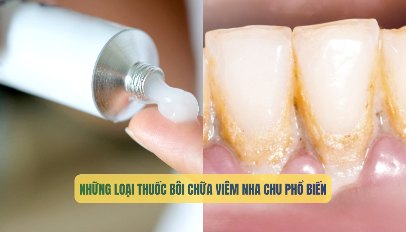 5 loại thuốc bôi chữa viêm nha chu phổ biến