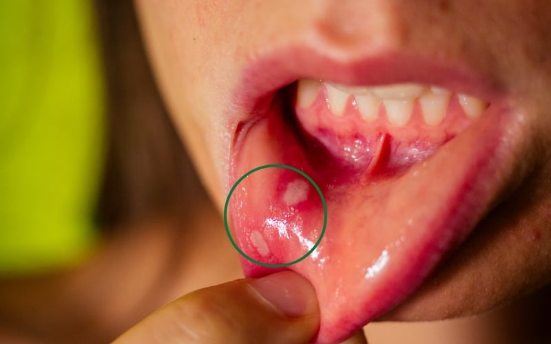 Biểu hiện của nhiệt miệng là xuất hiện các vết loét màu trắng trên niêm mạc miệng