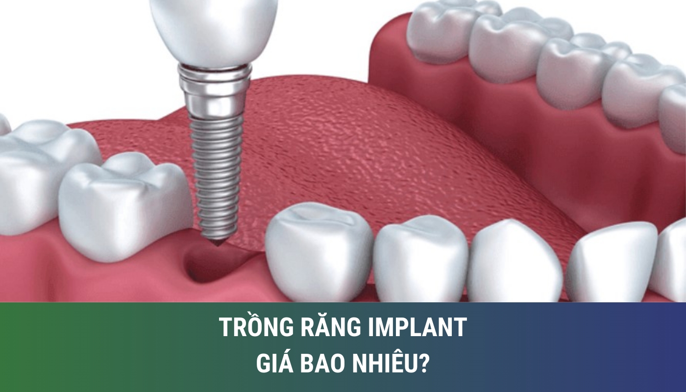 Trồng răng implant giá bao nhiêu?