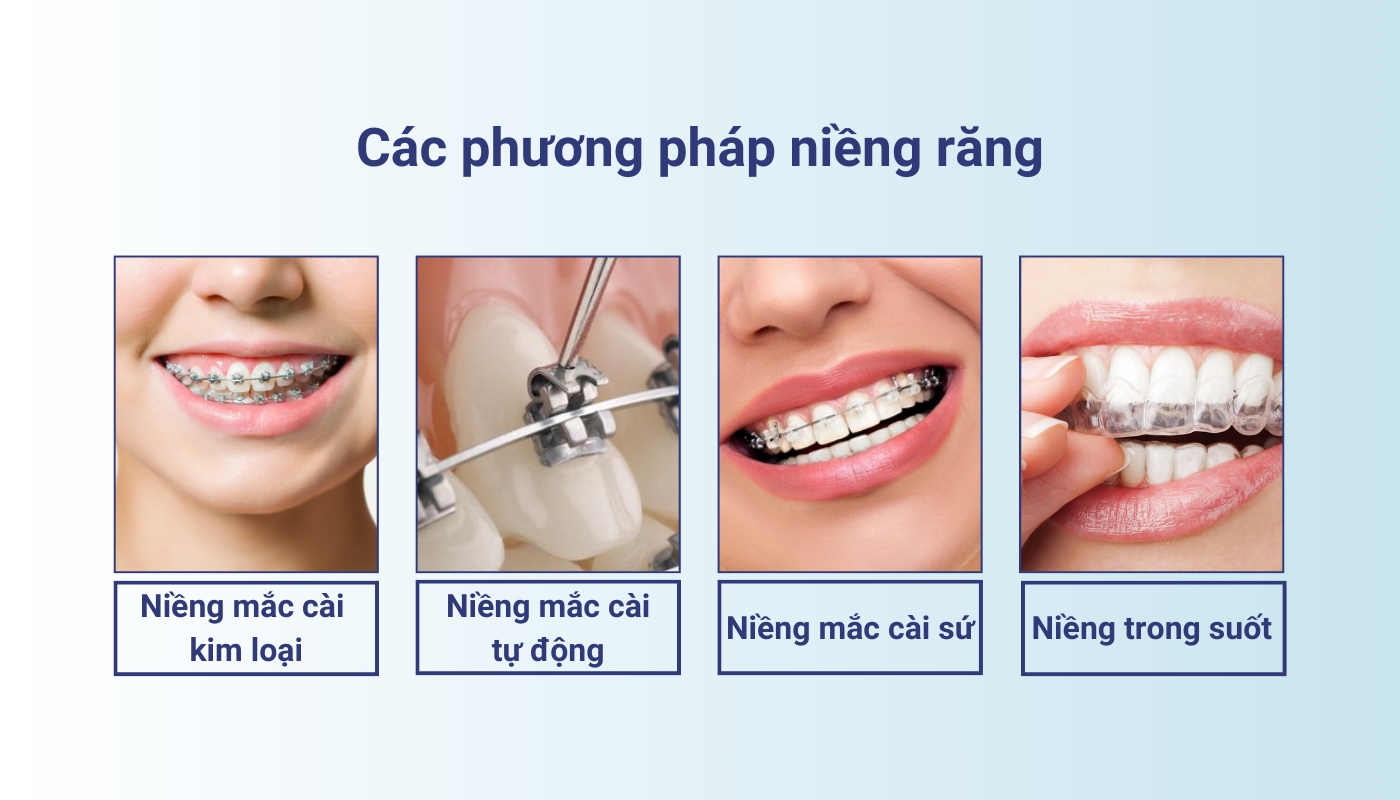 4 phương pháp niềng răng gồm: niềng mắc cài kim loại, niềng mắc cài tự động, niềng mắc cài sứ, niềng trong suốt