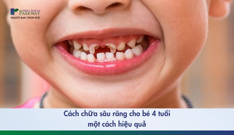 Cách chữa sâu răng cho bé 4 tuổi hiệu quả