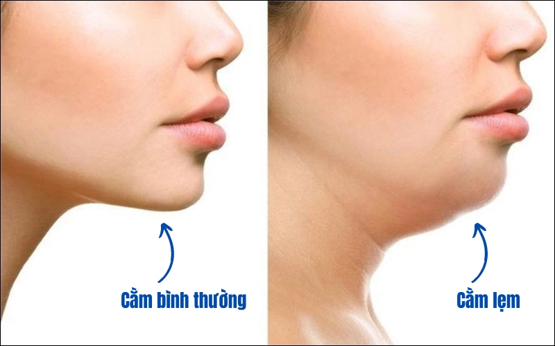 Cằm lẹm là tình trạng cằm bị ngắn và thụt vào trong so với xương hàm