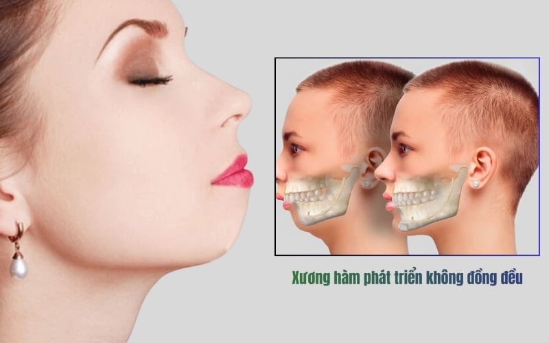 Xương hàm phát triển không đều là một trong những nguyên nhân gây cằm lẹm