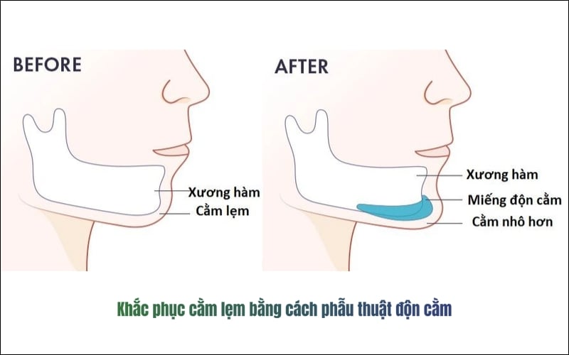 Phẫu thuật độn cằm lẹm