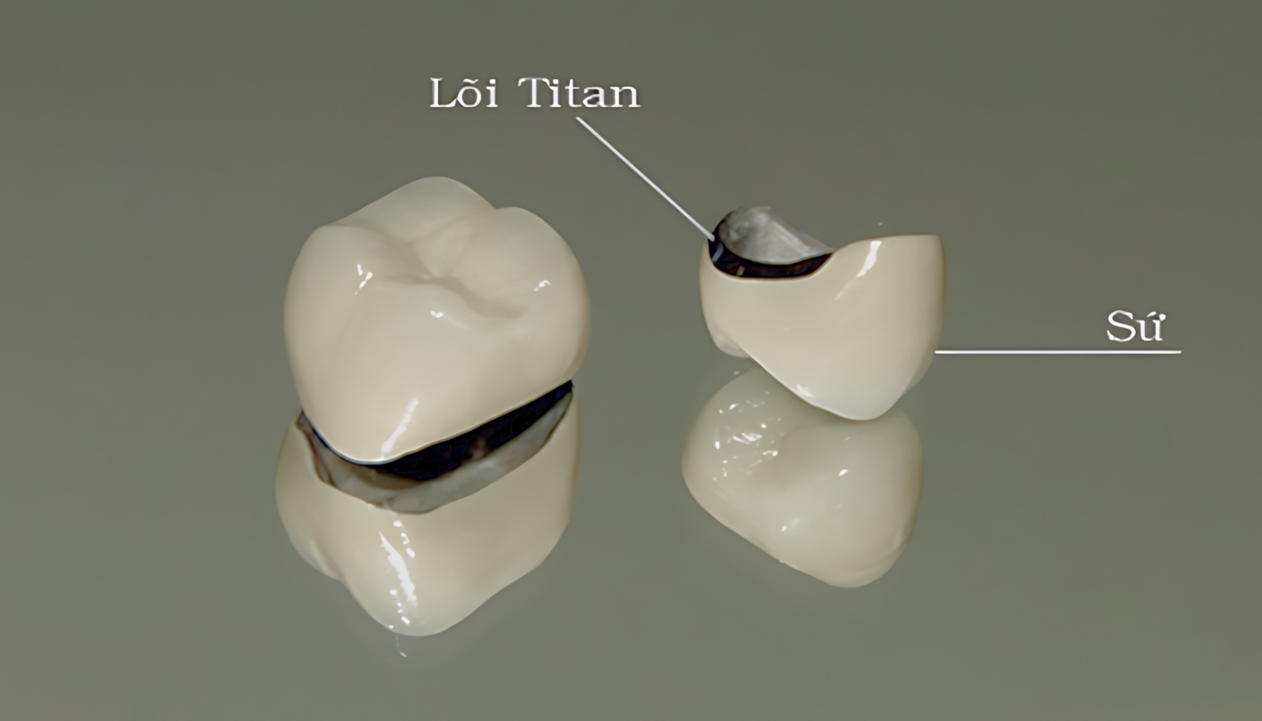 Cấu tạo răng sứ titan