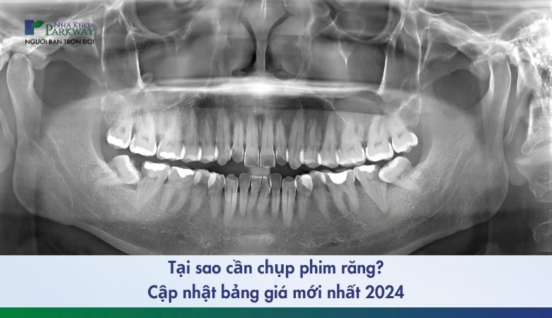 tại sao cần chụp phim răng, cập nhật bảng giá mới nhất 2024