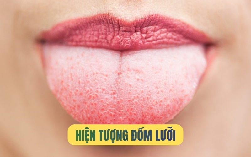 Hiện tượng đốm lưỡi và cách nhận biết