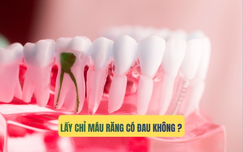 Lấy chỉ máu răng