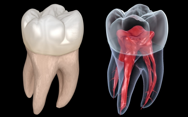 Chi phí lấy chỉ máu răng đối với răng có nhiều chân cao hơn so với răng một chân