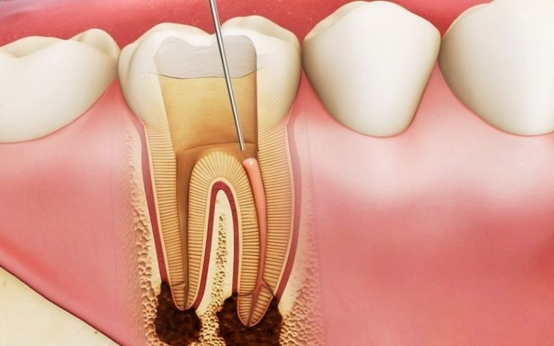 Trám răng có lấy chỉ máu răng không?