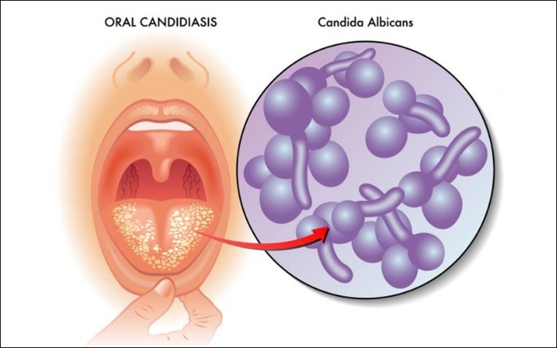 Lưỡi nổi hạt đỏ do nhiễm nấm