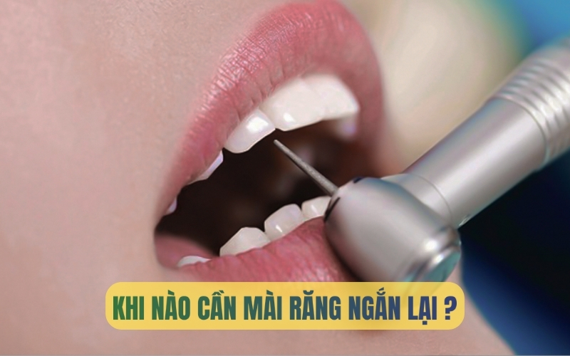 Tìm hiểu khi nào cần mài răng ngắn lại