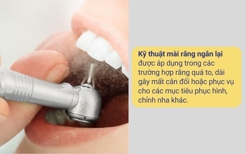 Mài ngắn răng là một kỹ thuật nha khoa được sử dụng phổ biến