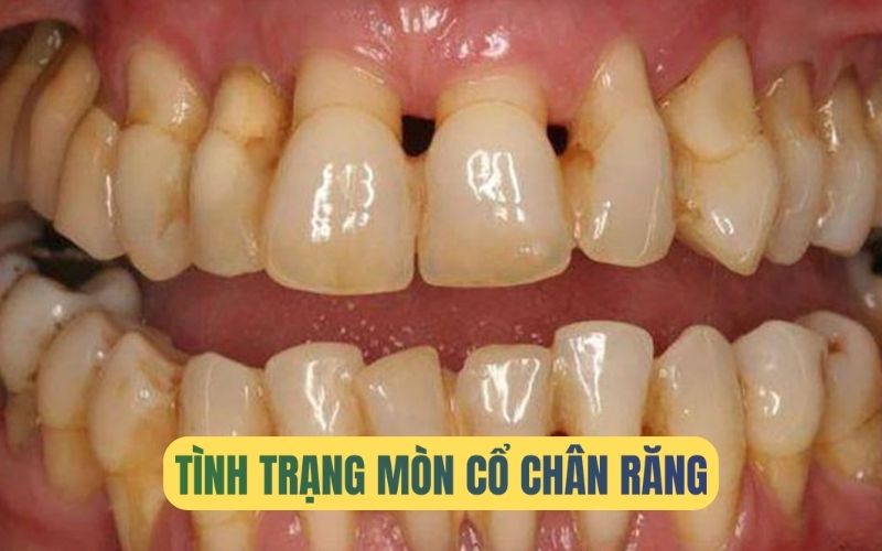 Nguyên nhân và cách khắc phục mòn cổ chân răng