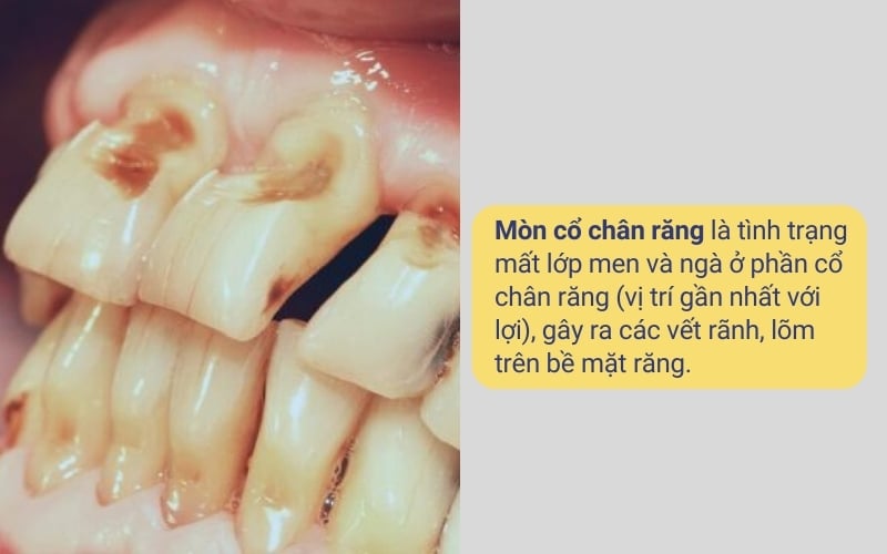 Mòn cổ chân răng là tình trạng mất lớp men và ngà ở phần cổ chân răng