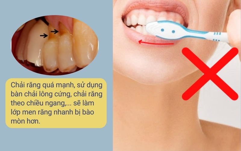 Chải răng sai cách là nguyên nhân gây mòn cổ chân răng