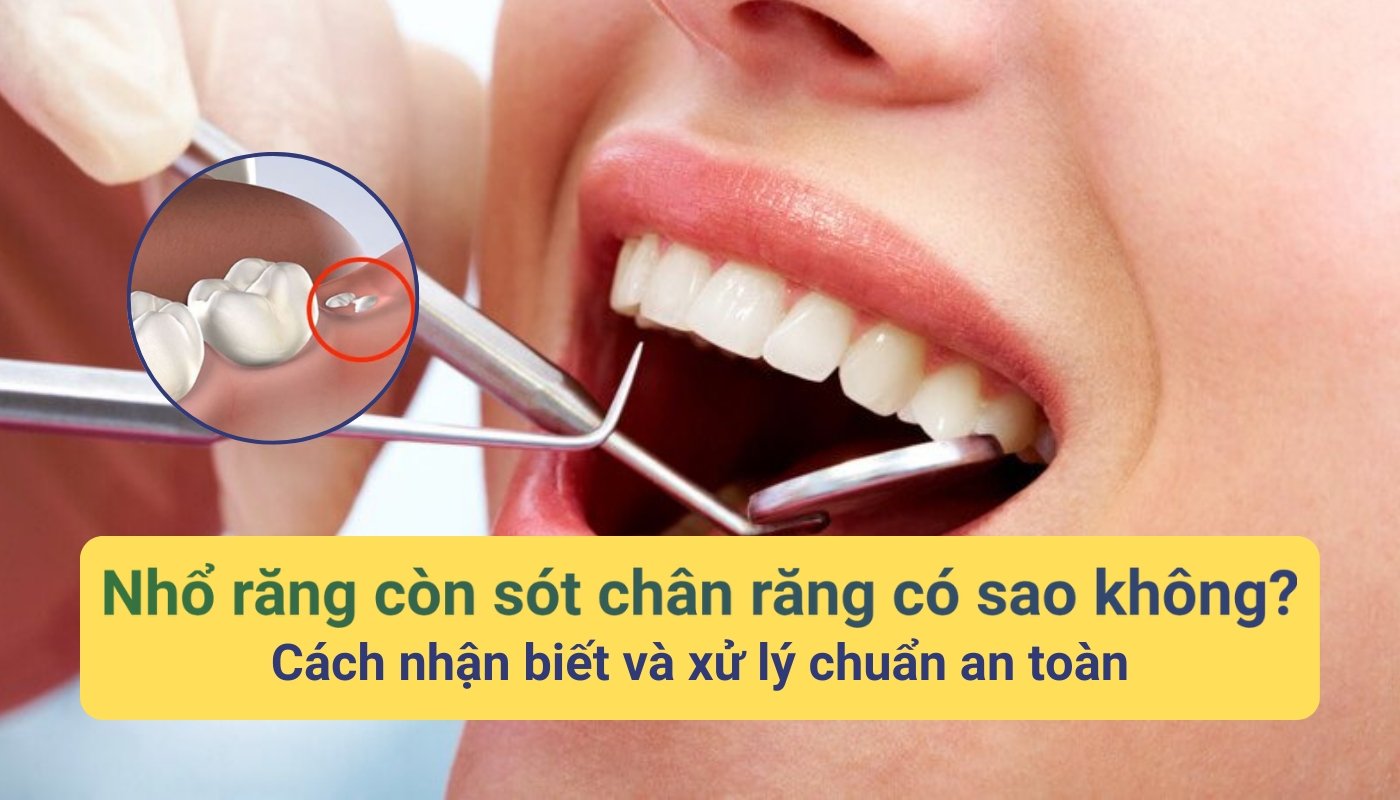 Nhổ răng còn sót chân răng có sao không