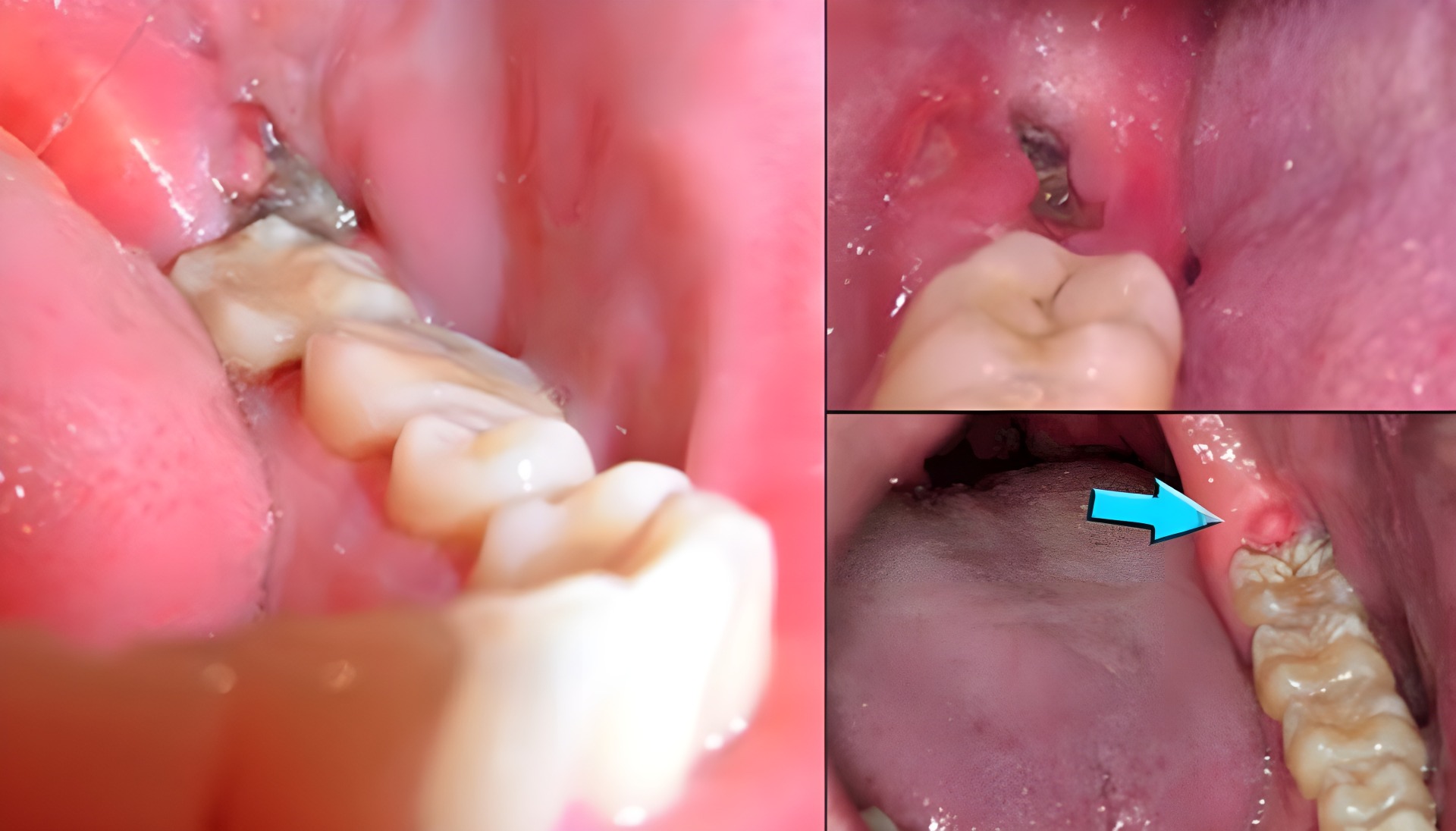 Nhổ răng sót chân răng gây đau nhức