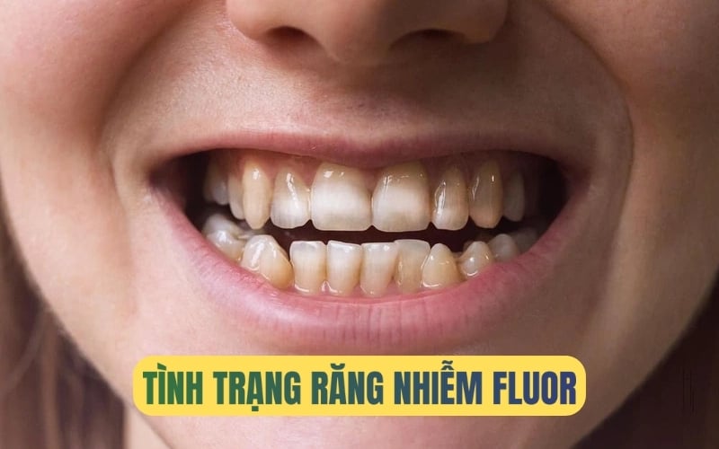 Tìm hiểu về tình trạng răng nhiễm fluor