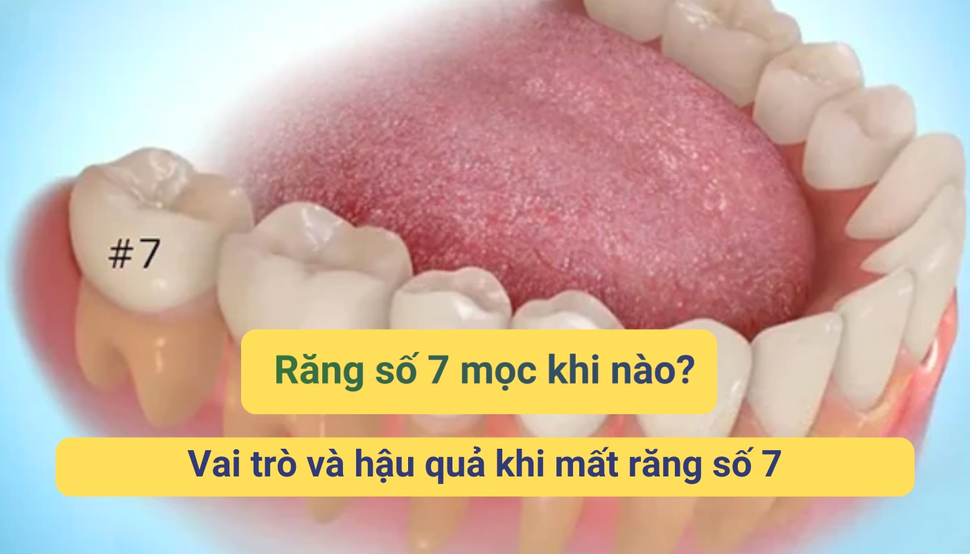 Răng số 7 mọc khi nào