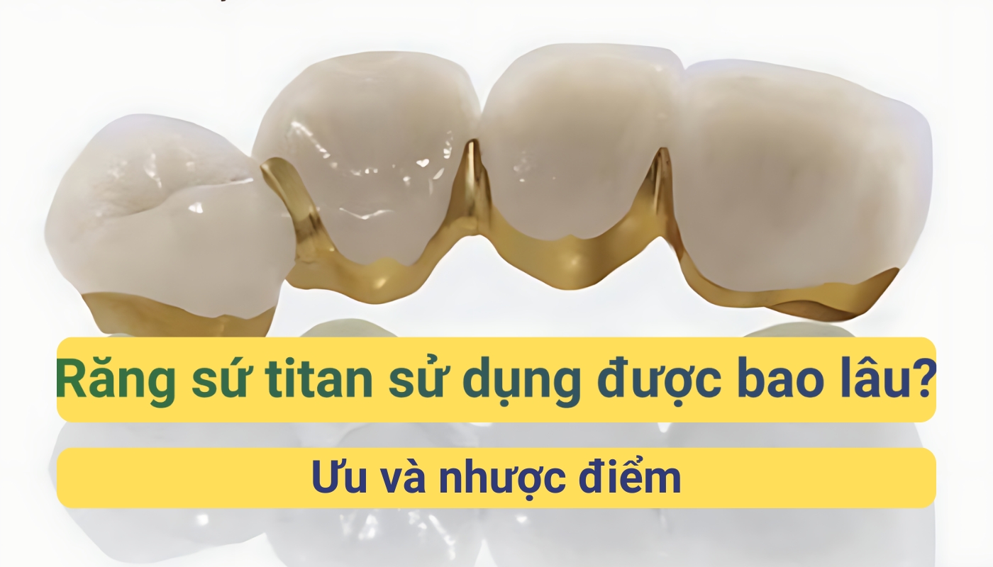 Rănh sứ titan sử dụng được bao lâu? Ưu và nhược điểm