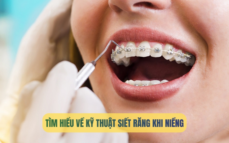 Siết răng khi niềng: Quy trình, thời gian và cách giảm đau hiệu quả