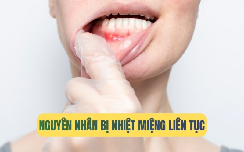 Tại sao bị nhiệt miệng liên tục? Nguyên nhân và cách phòng ngừa hiệu quả