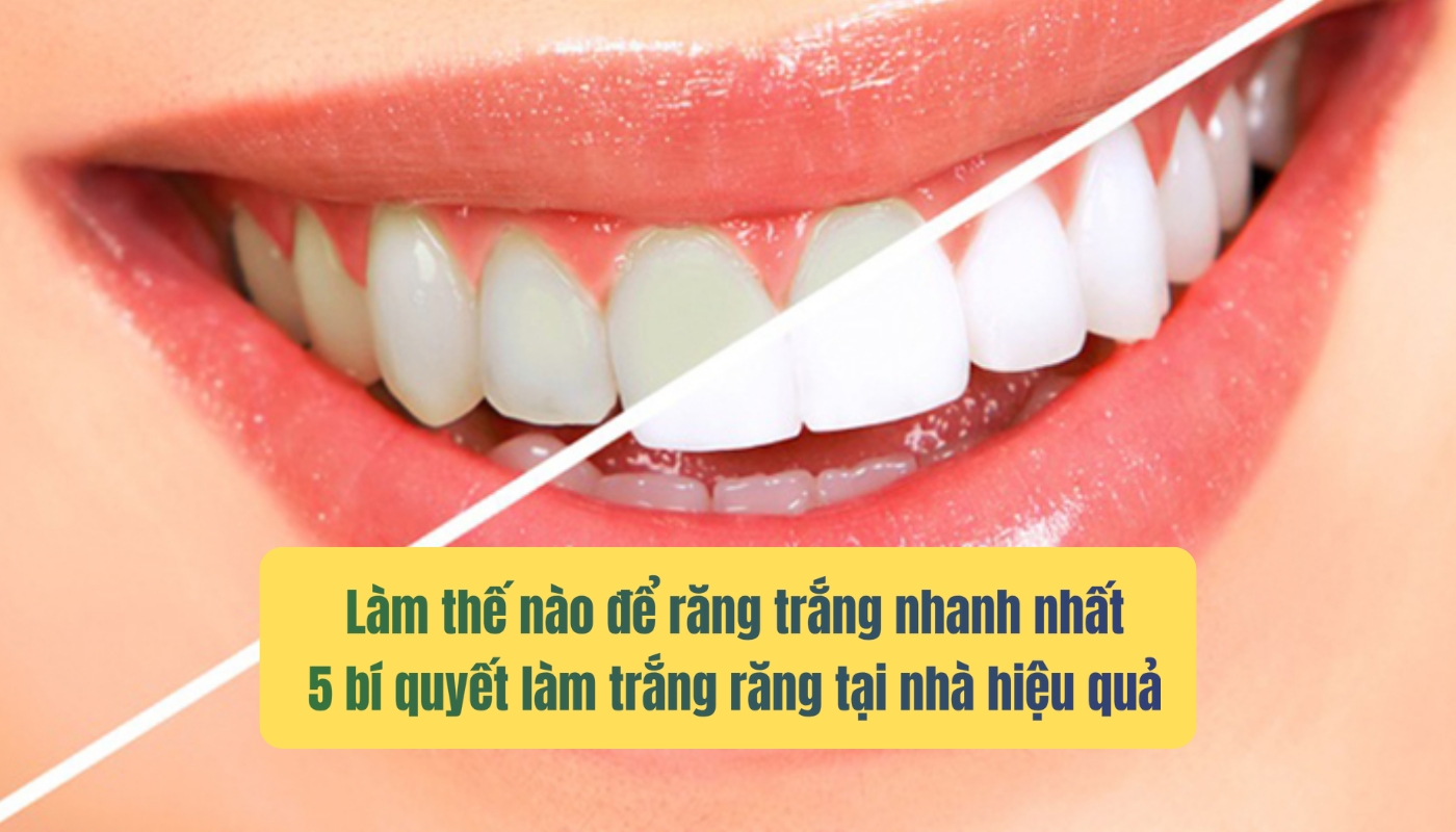 Làm thế nào để răng trắng nhanh nhất