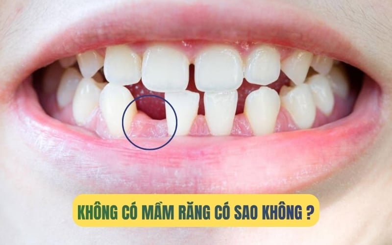 Không có mầm răng vĩnh viễn có sao không?