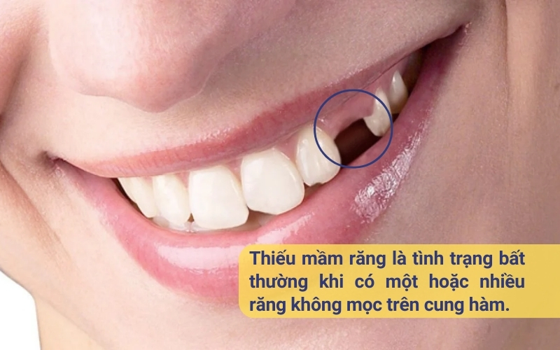 Mầm răng vĩnh viễn bị thiếu