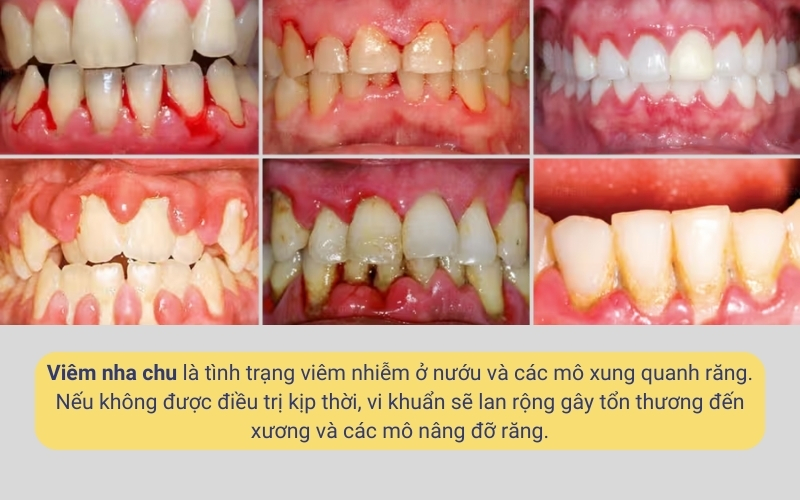 Viêm nha chu là tình trạng viêm nhiễm nghiêm trọng ở nướu và các mô xung quanh răng