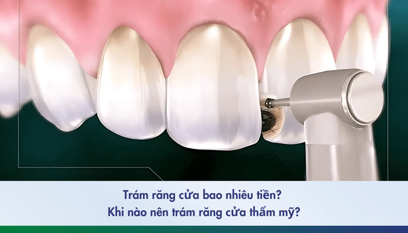 Trám răng cửa bao nhiêu tiền?