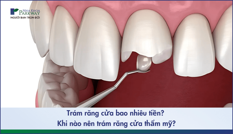 Trám răng cửa bao nhiêu tiền