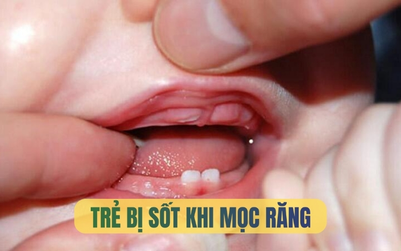 Trẻ mọc răng sốt mấy ngày thì khỏi? Khi nào nên đưa trẻ đi khám?