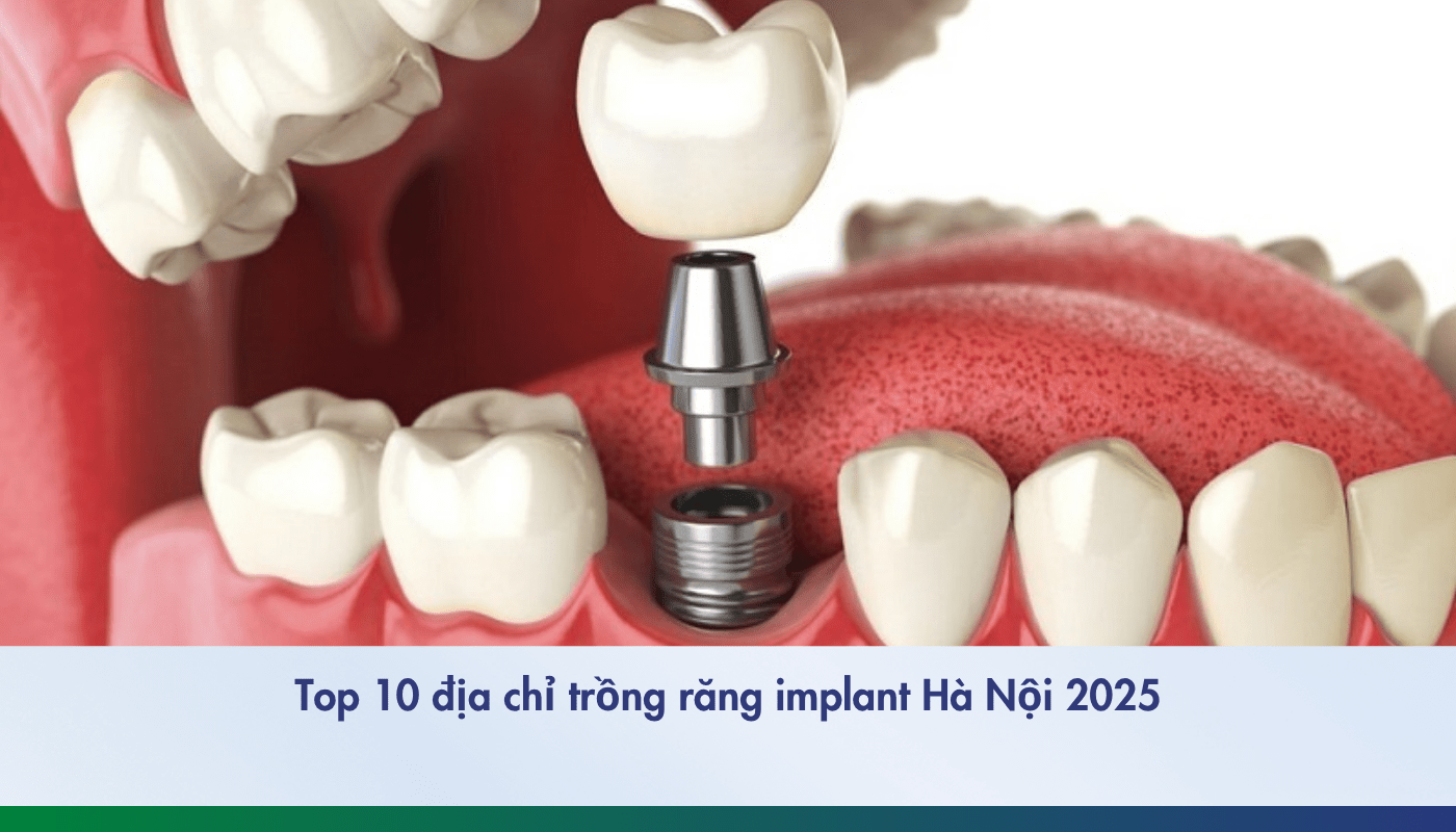 trồng răng implant