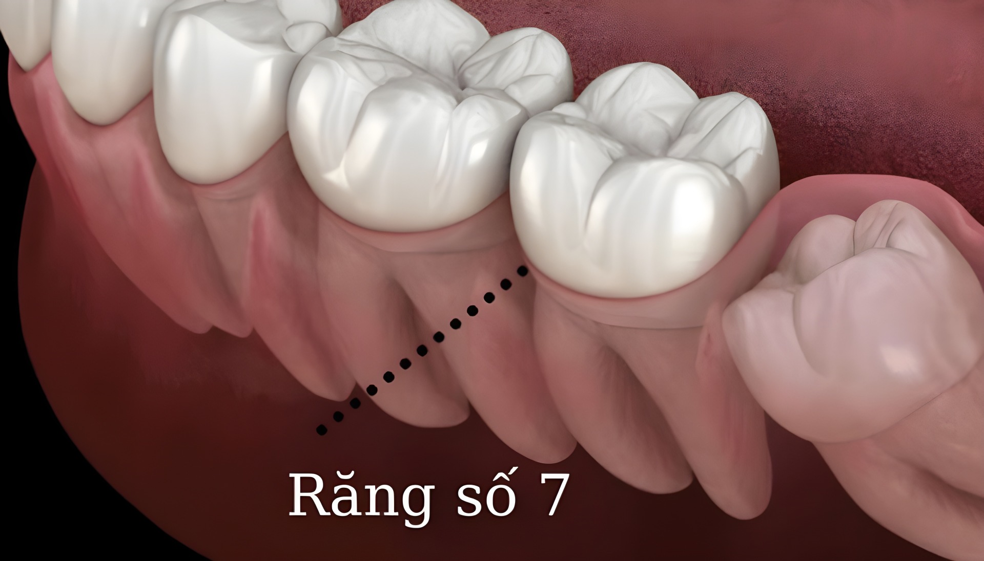 Hình ảnh răng số 7 có mặt nhai lớn