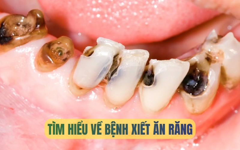 Xiết ăn răng: Nguyên nhân, dấu hiệu và cách khắc phục theo từng giai đoạn