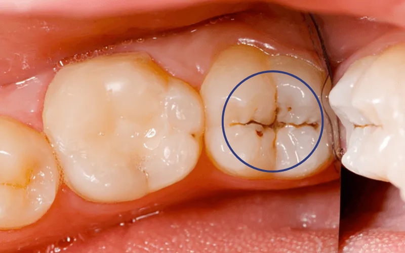 Dấu hiệu nhận biết xiết ăn răng