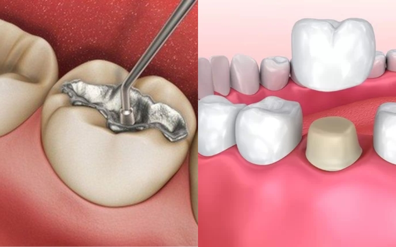 Cách điều trị xiết ăn răng ở giai đoạn tiến triển